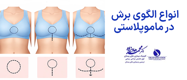 انواع الگوی برش در ماموپلاستی