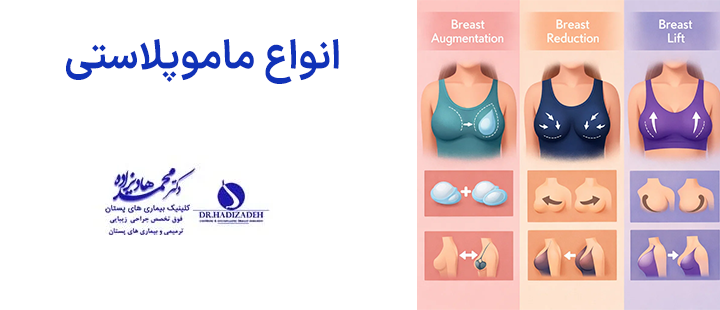 انواع ماموپلاستی
