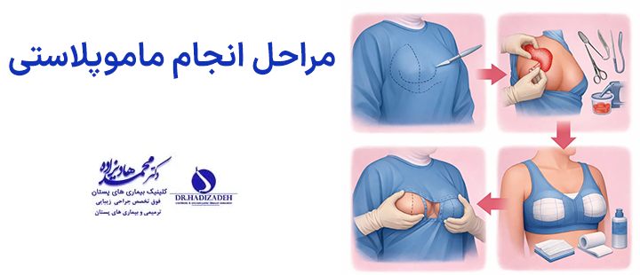 مراحل انجام ماموپلاستی